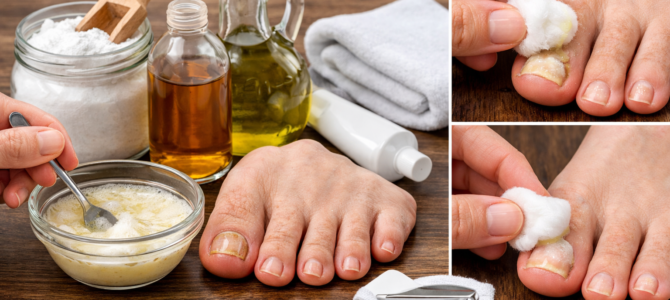 Cómo cuidar las uñas afectadas por hongos con alternativas que muchas personas utilizan.