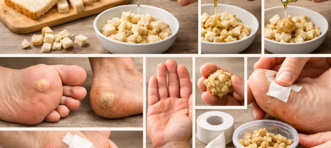 Un método sencillo para tratar los callos en casa y mejorar el cuidado de los pies. Un método sencillo para tratar los callos en casa y mejorar el cuidado de los pies.