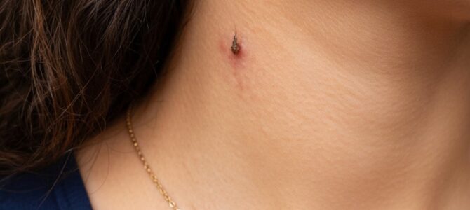 A mi hija adolescente le sale un bultito con forma de hilo en el cuello y mañana tiene un recital: ¿qué es?