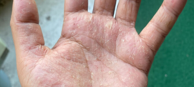 Piel reseca, agrietada y con picazón en las manos: qué es la dermatitis y cuándo prestarle atención Piel reseca, agrietada y con picazón en las manos: qué es la dermatitis y cuándo prestarle atención