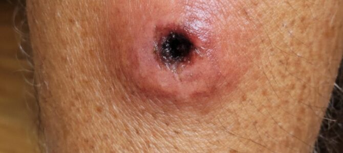 Llaga roja con el centro oscuro y hundido en la piel: qué puede ser y cuándo es una emergencia Llaga roja con el centro oscuro y hundido en la piel: qué puede ser y cuándo es una emergencia