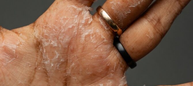 Se te pela la piel de las manos: por qué pasa y cómo cuidarla Se te pela la piel de las manos: por qué pasa y cómo cuidarla